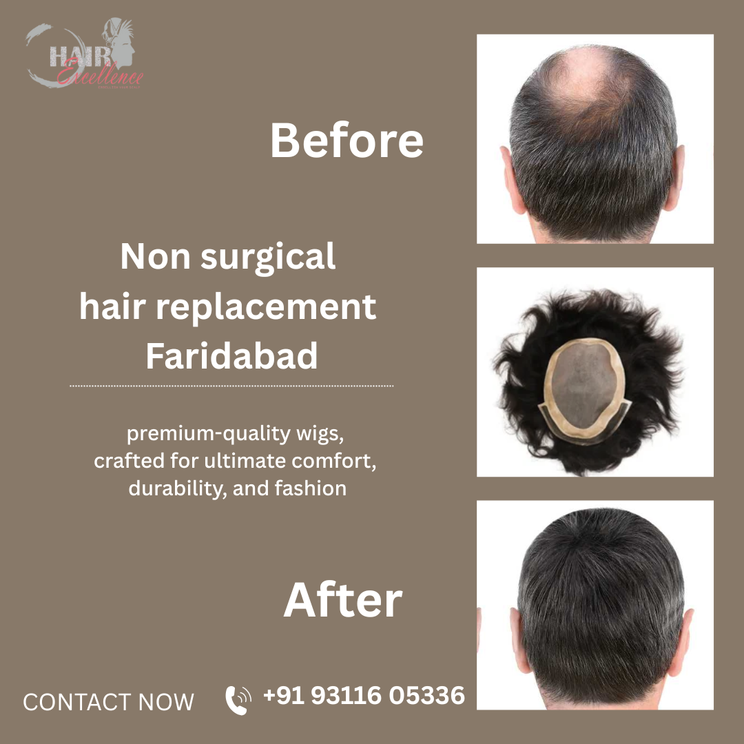 Non surgical hair replacement Faridabad